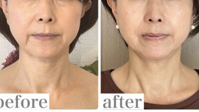 フェイスライン引きあがるのに、ほうれい線は変わらない