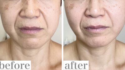 深いほうれい線が薄くなった48歳のお客様