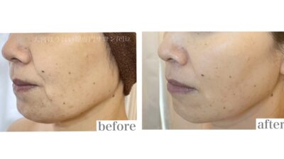 ヒアルロン酸以外の方法でほうれい線を薄くしたかった