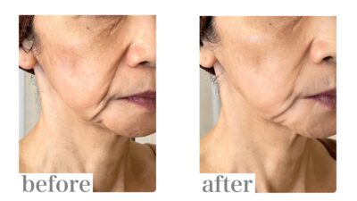 ヒアルロン酸を打つ前にできること