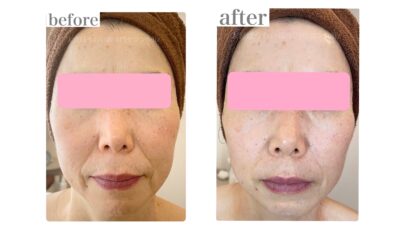 マスクで隠せる季節がきた！って安心していませんか？