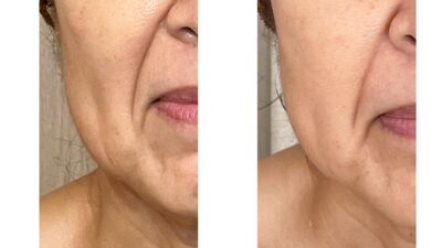 コツコツお手入れを続けたら、こんなにほうれい線が浅くなりました