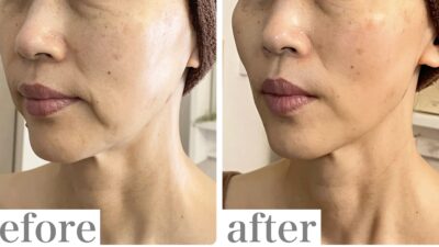 ヒアルロン酸や糸を入れなくても、マリオネットラインが綺麗に引きあがりました