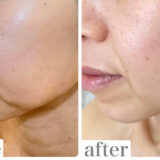 もう変わらないと思っていた口元のたるみが引きあがりました