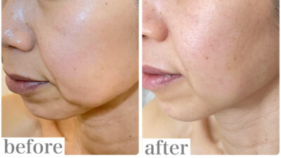 もう変わらないと思っていた口元のたるみが引きあがりました