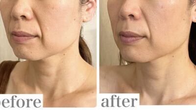 《タイプ別ほうれい線ケア②》小鼻の横から深く入るタイプのほうれい線