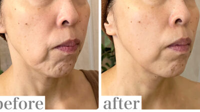 口元のポニョっとしたたるみが目立たなくなった50代のお客様