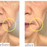 ヒアルロン酸や糸リフト以外の方法でほうれい線を薄くしたかったお客様のお肌の変化