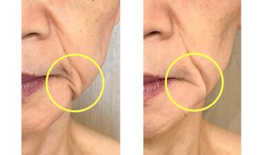 ヒアルロン酸や糸リフト以外の方法でほうれい線を薄くしたかったお客様のお肌の変化