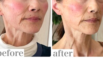 一番気になっていた口元のたるみとシワが目立たなくなりました