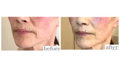 《お客様の変化》口元のたるみ、シワが目立たなくなりました