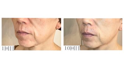 《お客様の変化》美顔器を使っても変化が分からなかったほうれい線が薄くなりました